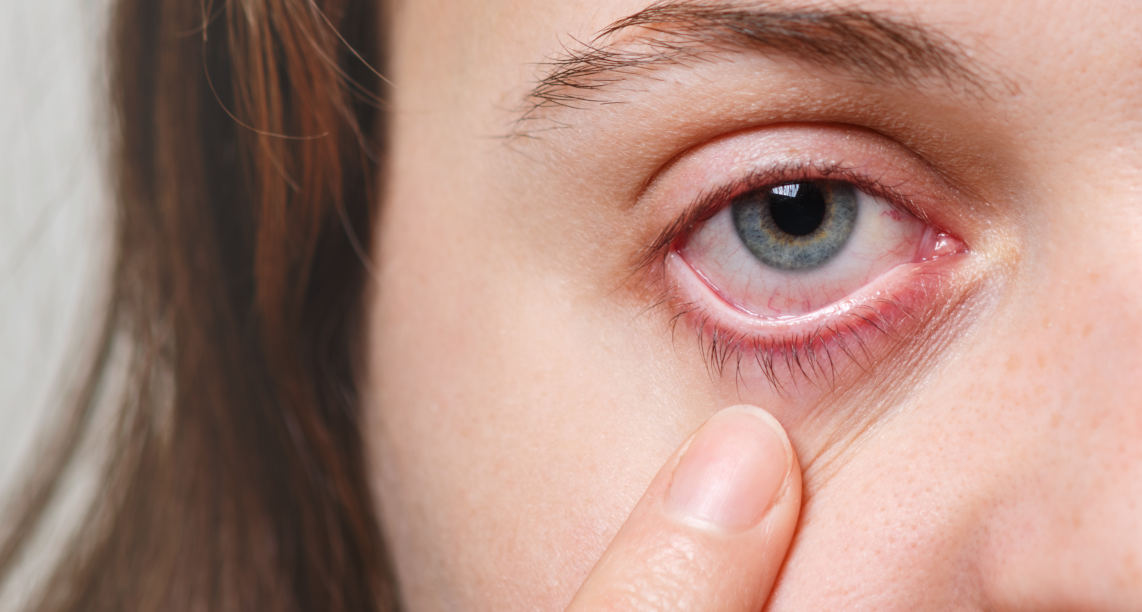 Medicine, health care and eyesight concept. Unrecognizable female shows her inflated red eye with blood capillary, has conjuctivitis. Woman with injured eye